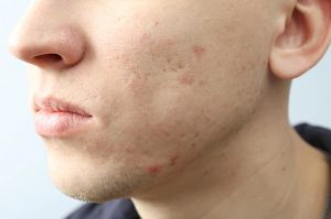Les cicatrices d’acné